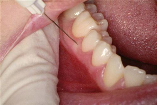 بی حسی در دندانپزشکی، دندانپزشکی