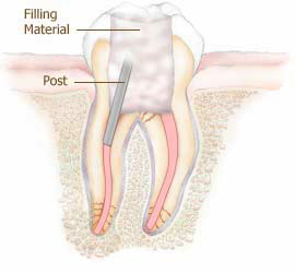 درمان ریشه، همکاران دندانپزشک